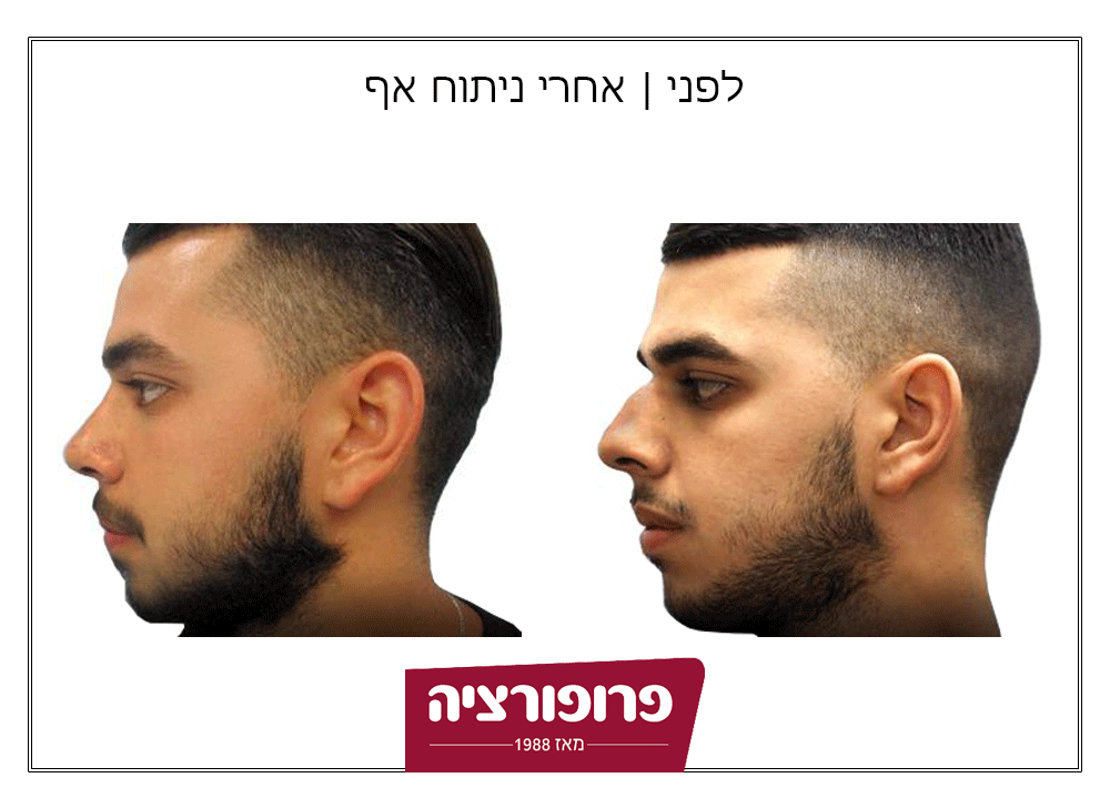 לפני ואחרי ניתוח אף | רשת מרפאות פרופורציה